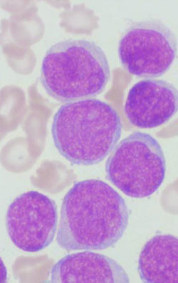 lymfoblastisk leukemi