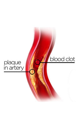 atherosclerosis