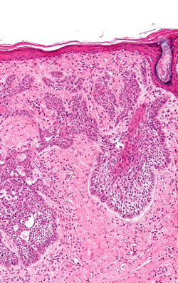basal cell carcinoma-symptoms