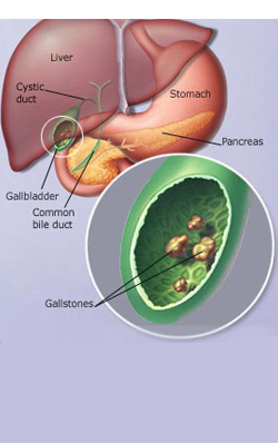 Gallstones Treatment