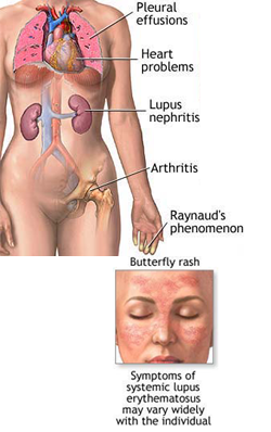Lupus-Symptoms and Complications