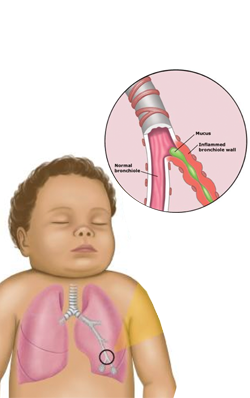 Bronchiolitis - A short discussion