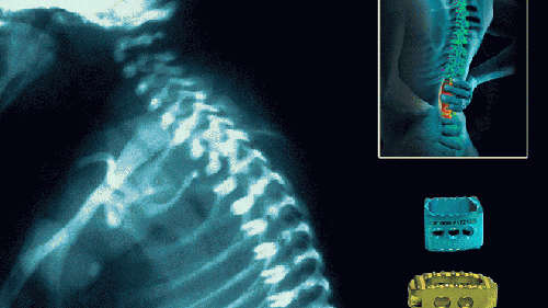 spinal implant